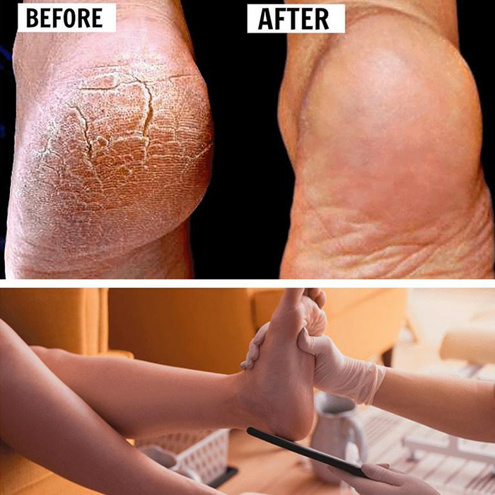 FootFile, la lima manuale definitiva per pedicure - Image 7
